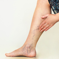 Arterosclerosis Tromboflebitis